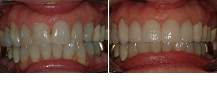before and after dental photos - Avery & Meadows Dental Partnership