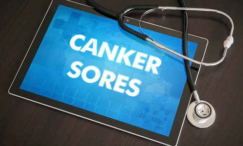 canker sore