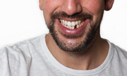 man with missing tooth