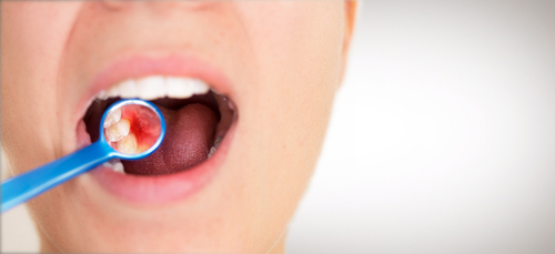 looking at gums with mirror