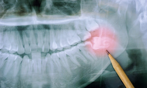 wisdom teeth